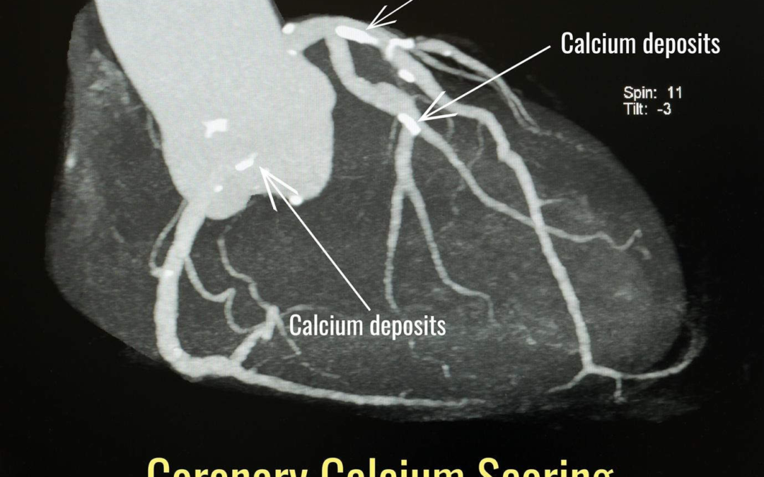 Coronary Calcium Score: A Simple Heart Test That Can Save Your Life
